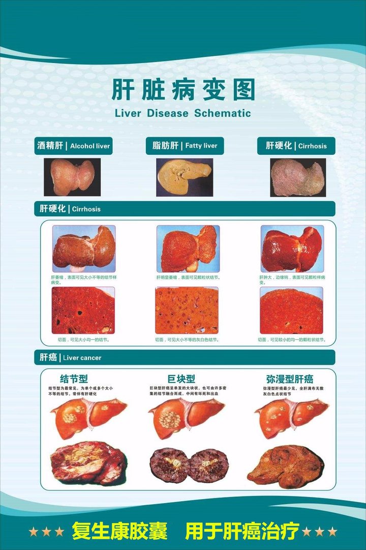 肝癌有什么早期症状？早期症状图是什么样子的呢？