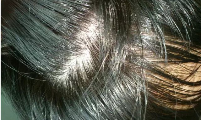 头发为什么会油