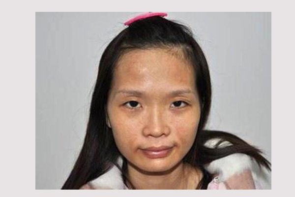 斑分为哪几种都有什么斑