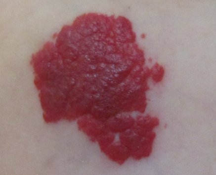 毛细血管瘤图片是什么样子的？