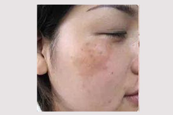 斑分为哪几种都有什么斑