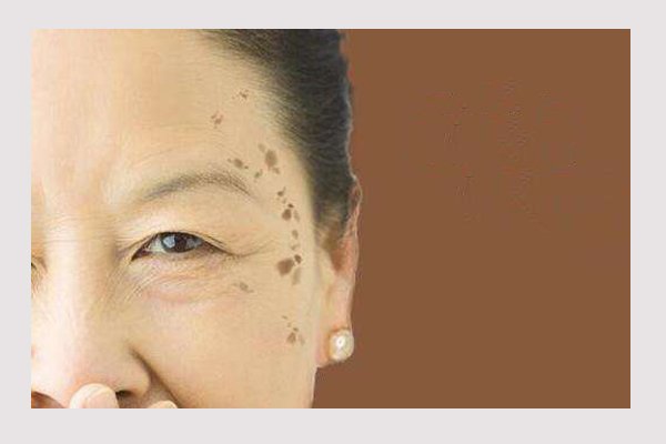 斑分为哪几种都有什么斑