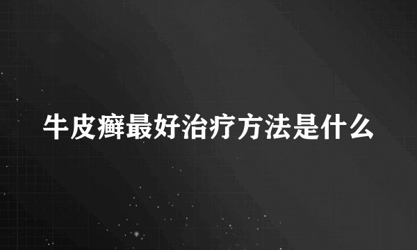 牛皮癣最好治疗方法是什么