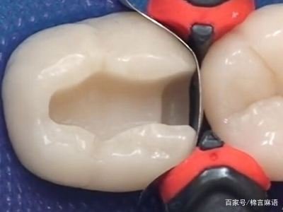 牙齿断了一半怎么办哪!