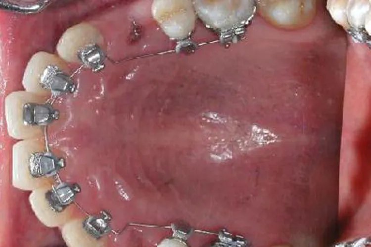 牙齿矫正图片