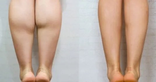 肌肉小腿怎么瘦成筷子腿肚子