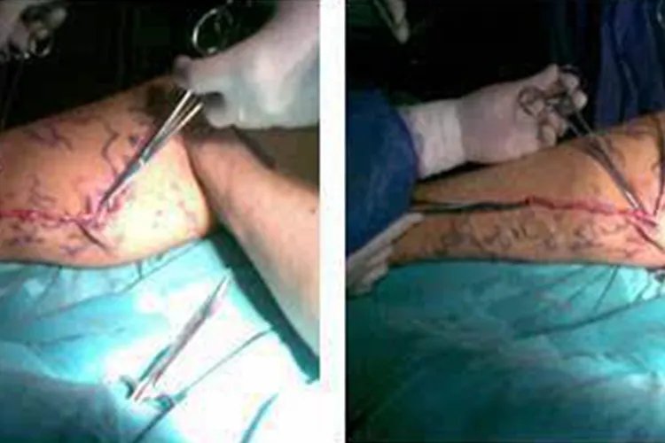 静脉曲张怎么治疗最好的方法腿部图片