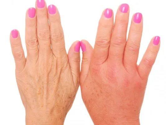 手上毛孔粗怎么治疗