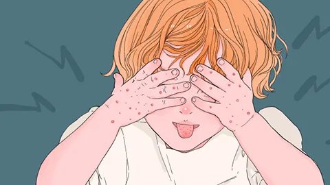 儿童磕巴该怎么办