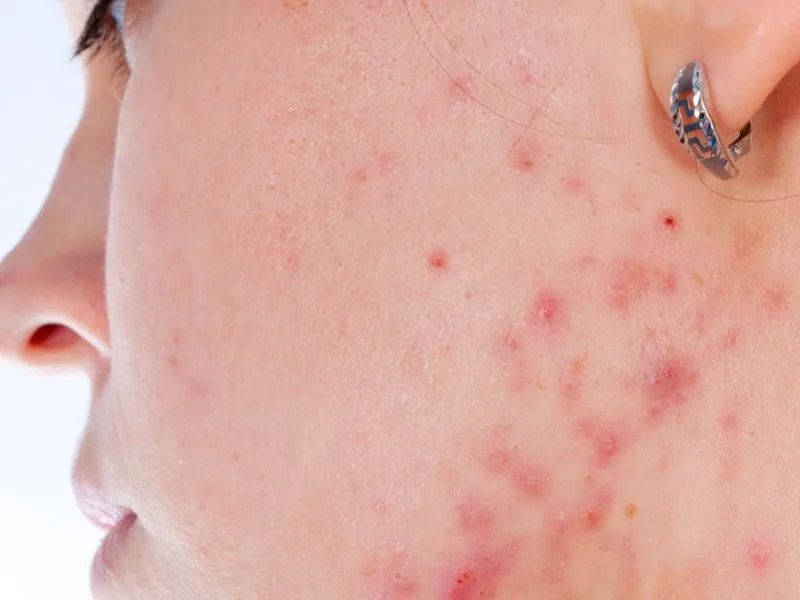 光子嫩肤去痤疮痕的原理