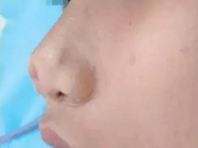 先天性鼻正中裂鼻部畸形图片