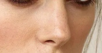 假体隆鼻好还是注射隆鼻好