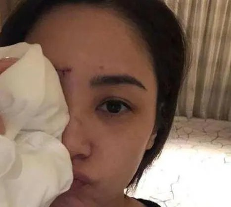 阿娇晒伤口照片，伤势恢复的怎样了？