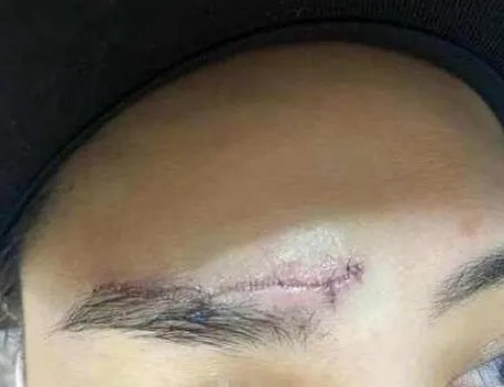 阿娇晒伤口照片，伤势恢复的怎样了？