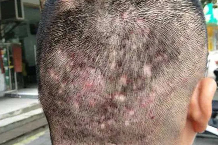 毛囊炎变成硬疙瘩图片