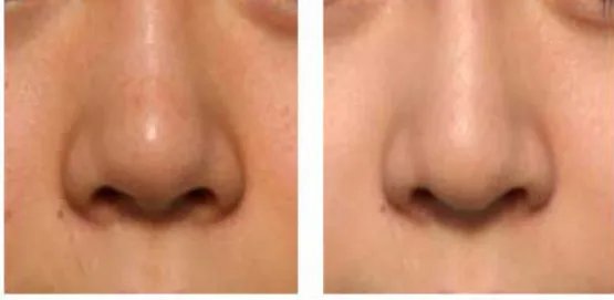 玻尿酸隆鼻前后对比照