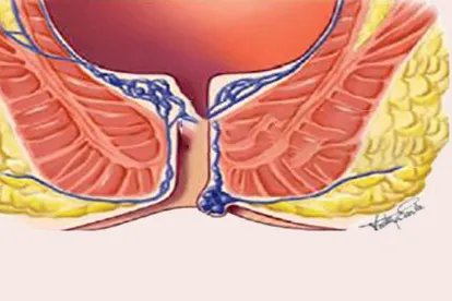 肛门正常图与痔疮图片