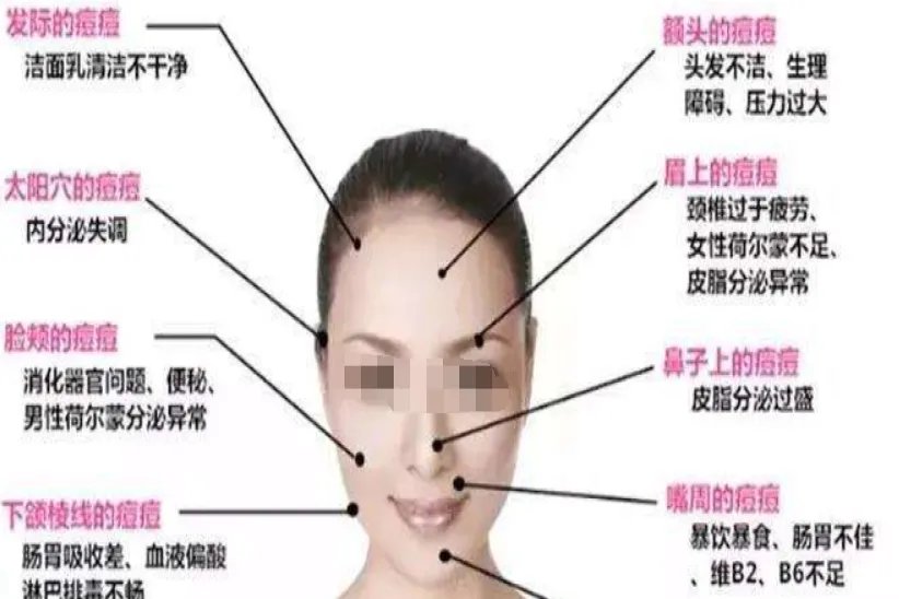 脸上各部位长痘痘图解图和原因