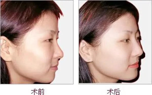 北京医院哪家做鼻部手术好