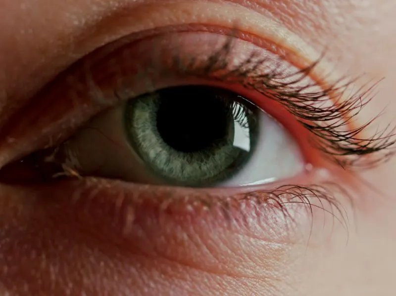 怎么样去眼角皱纹