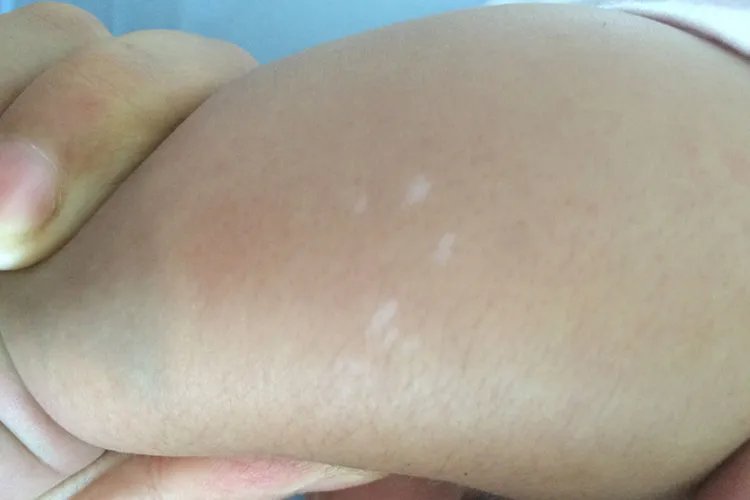 小孩身上很多一块块白色的图片