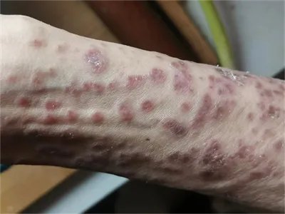 急性移植物抗宿主病胳膊症状图片