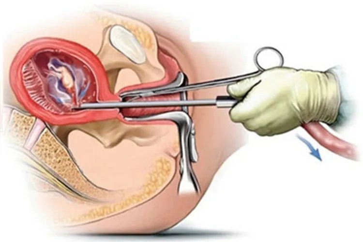 清宫怎么做的图解