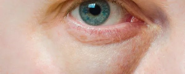 去眼袋手术多少钱