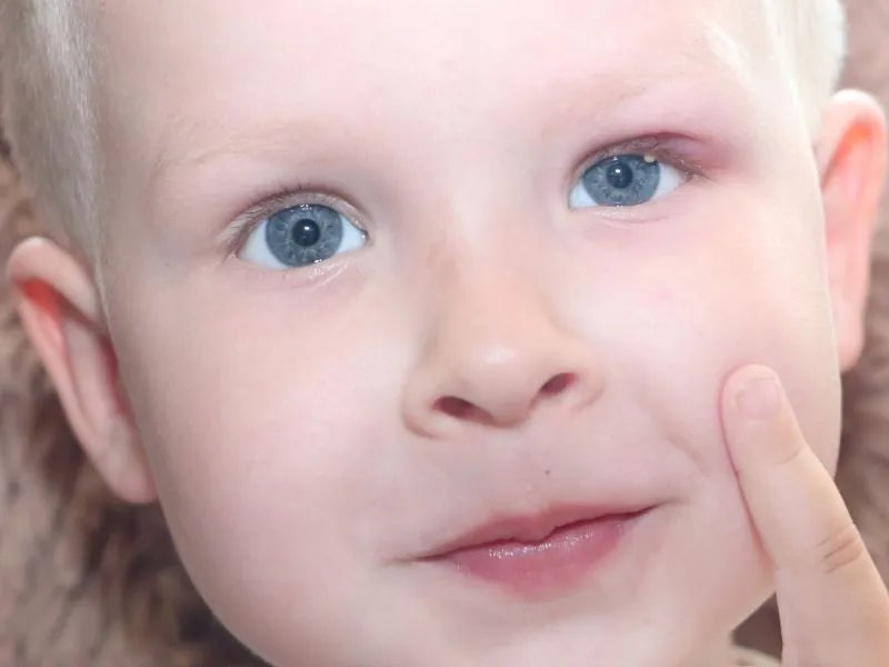 儿童脸上长斑的原因