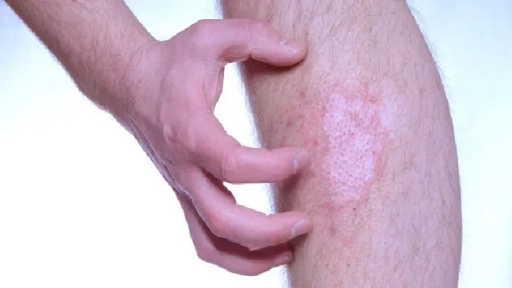 牛皮癣的治疗土方法