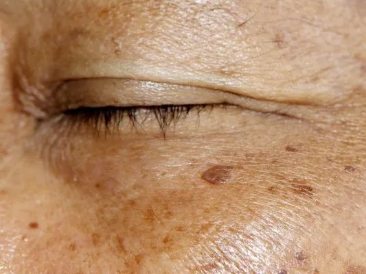 眼周色斑怎么处理