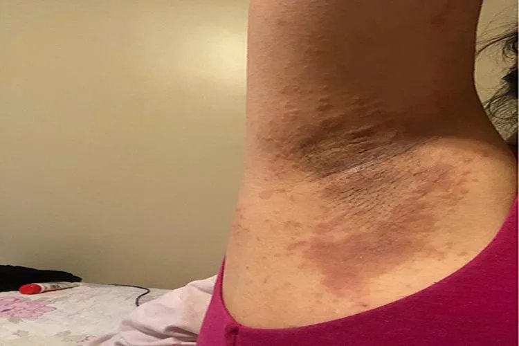 女生腋下皮肤病图片大全