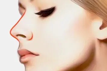 歪鼻矫正价格是多少