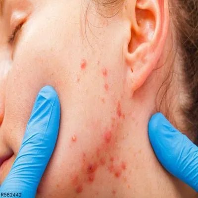 治痤疮的方法有哪些 盘点治痤疮的四个方法