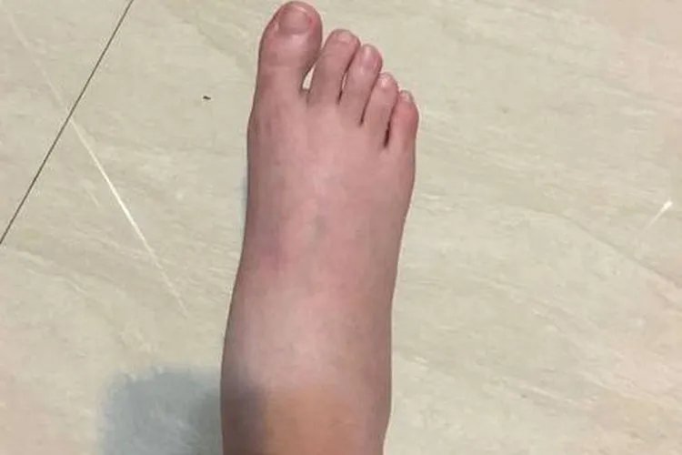 静脉曲张怎么治疗最好的方法腿部图片