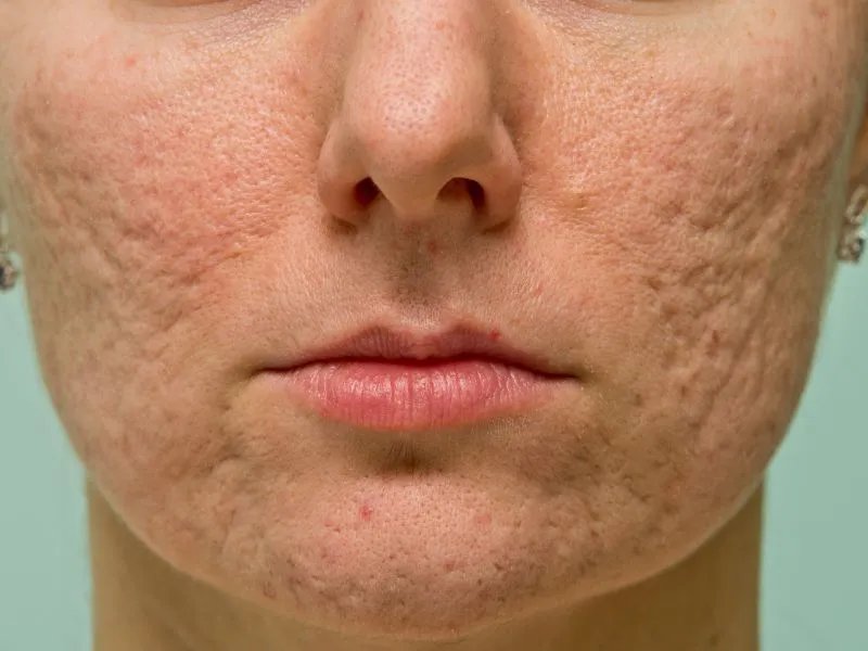 脸上皮肤很粗糙怎么办