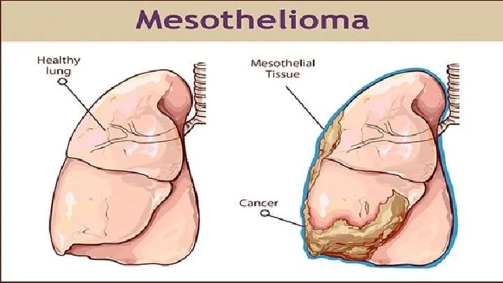 两个月宝宝肺炎症状有哪些
