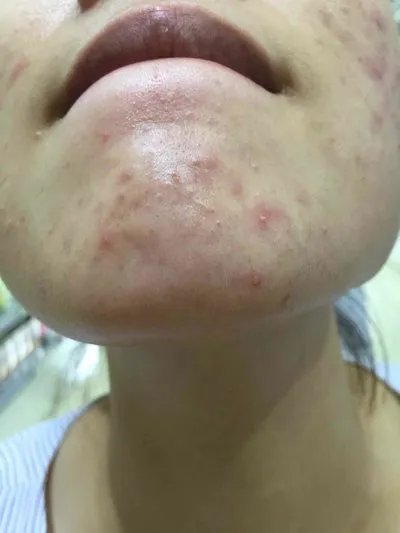 激光去青春痘好吗？