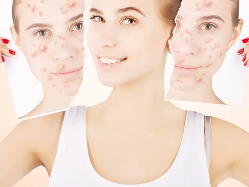 祛痘祛疤的方法