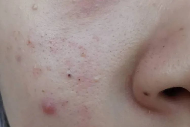 脸上长痘痘的原因图解