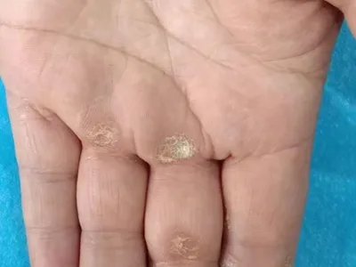 手部湿疹手指皮肤粗糙图片