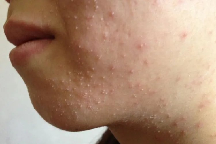 脸上长痘痘的原因图解