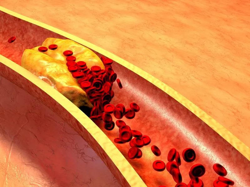 胆结石要怎么治疗