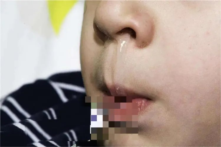 过敏是什么样子的图片