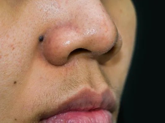 点痦子方法有哪些