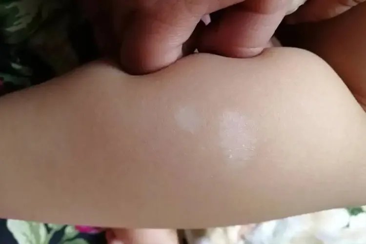 小孩身上很多一块块白色的图片