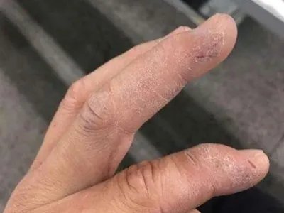 手部湿疹手指皮肤粗糙图片