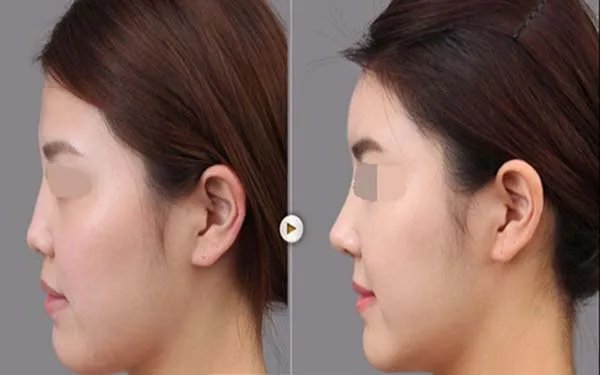 北京医院哪家做鼻部手术好