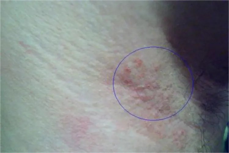 女生腋下皮肤病图片大全