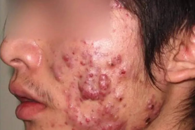 脸上长痘痘的原因图解